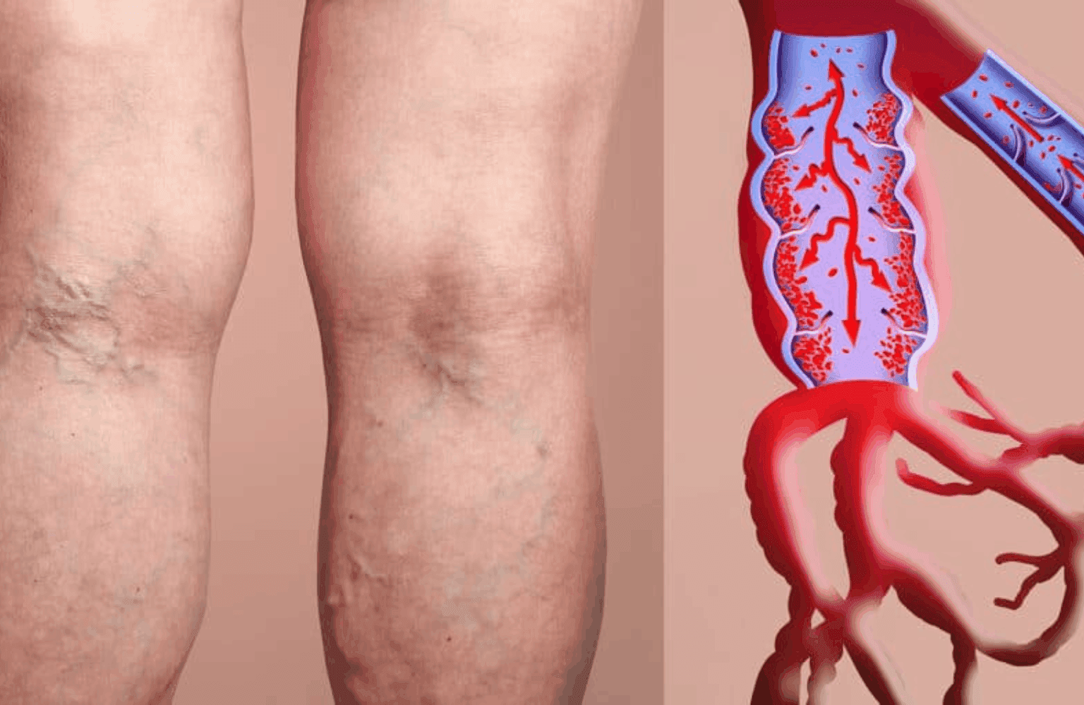 Deep Vein Thrombosis Symptoms and Causes