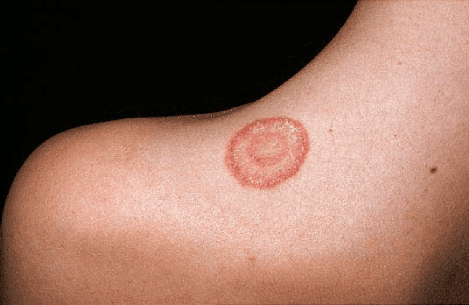 Ringworm