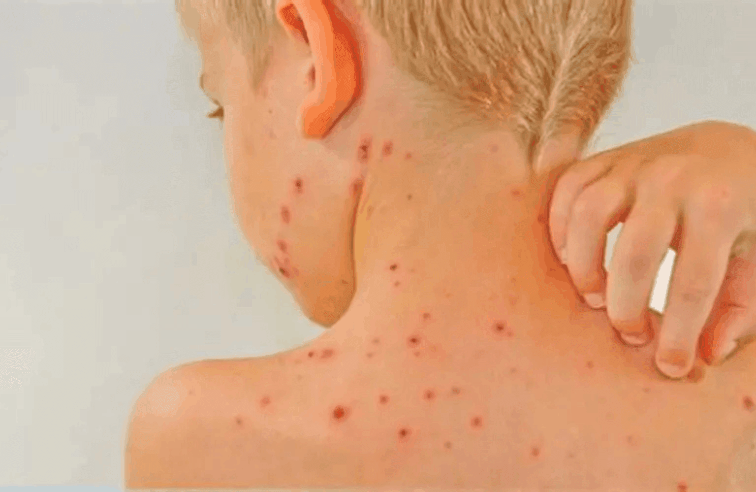 Chickenpox
