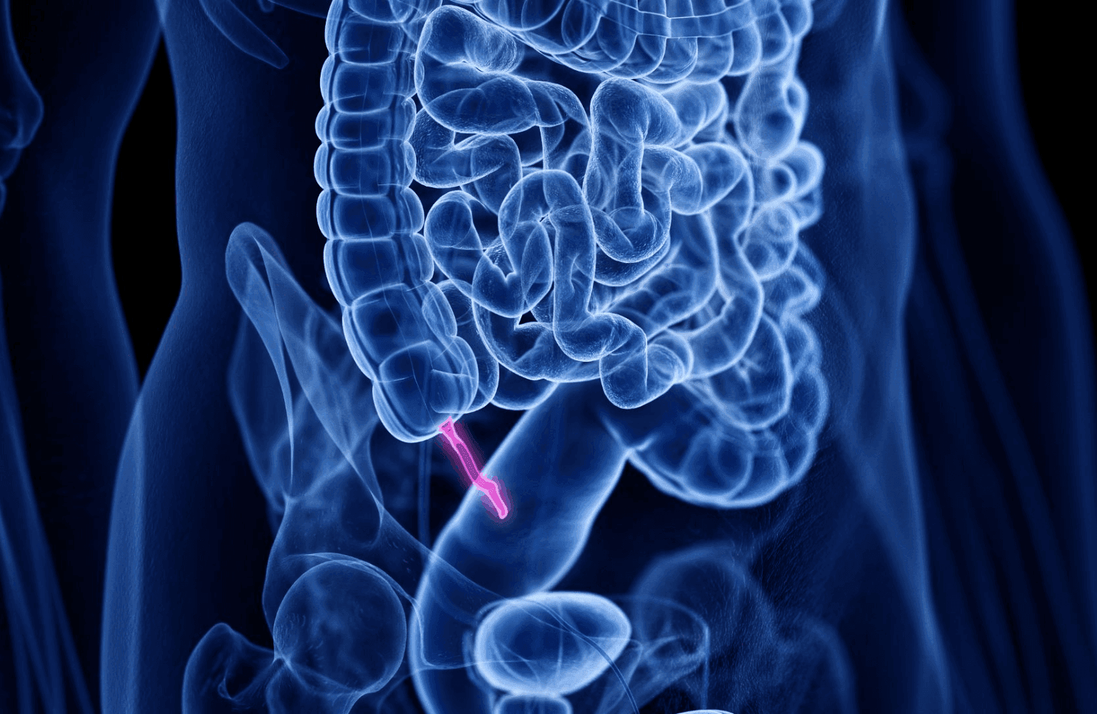 Appendicitis Causes and Symptoms