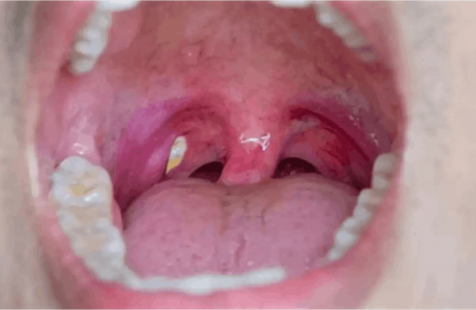Tonsillitis