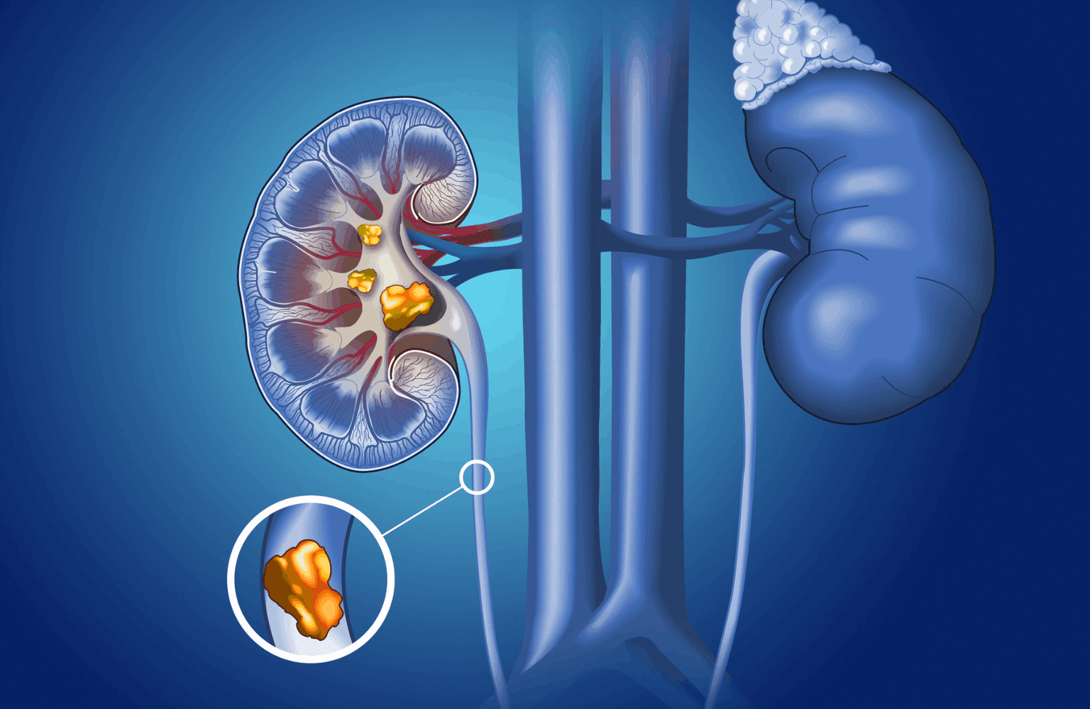 Kidney stones Symptoms and Causes