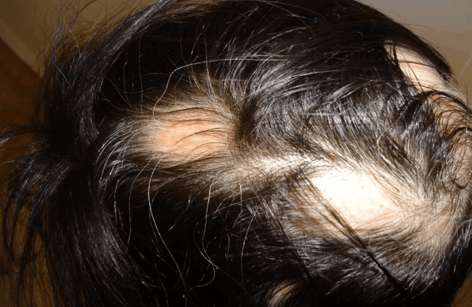 Alopecia