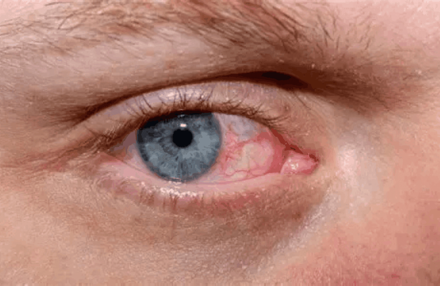 Dry eye