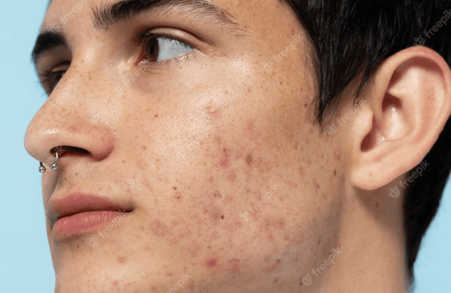 Acne