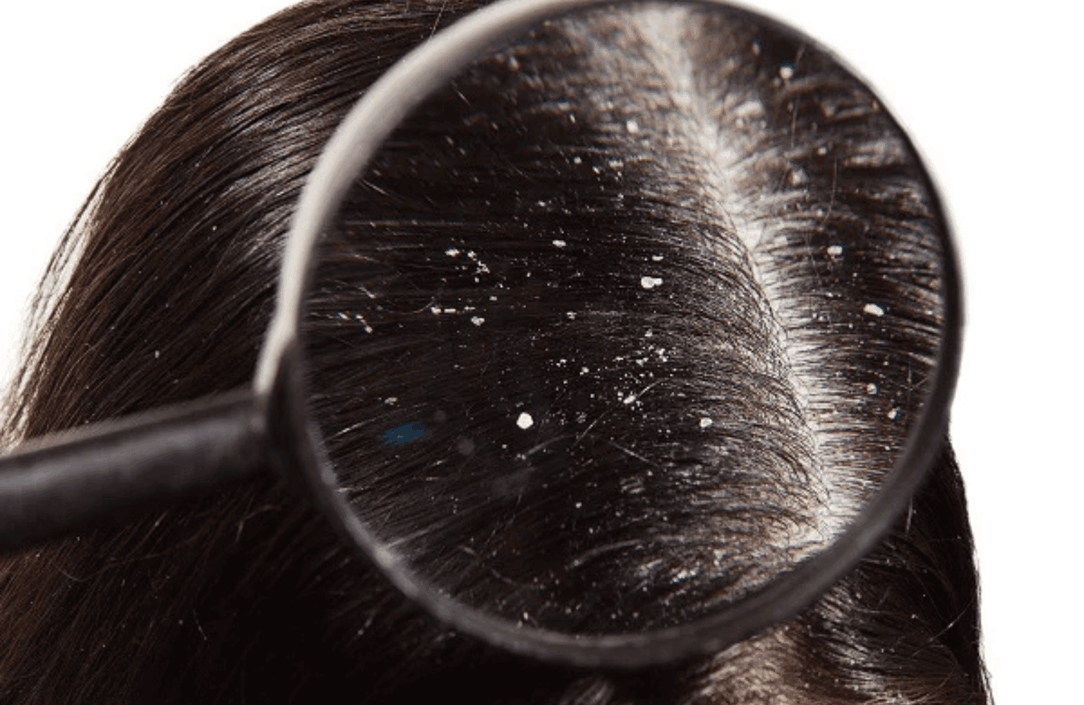 Dandruff Home Remedies and the Ayurvedic View