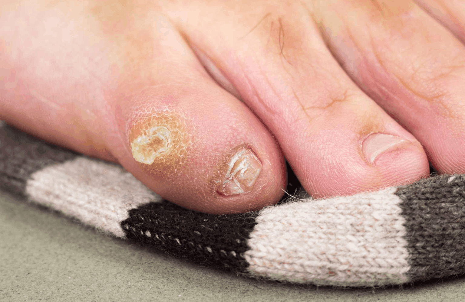 Corns Causes and Symptoms