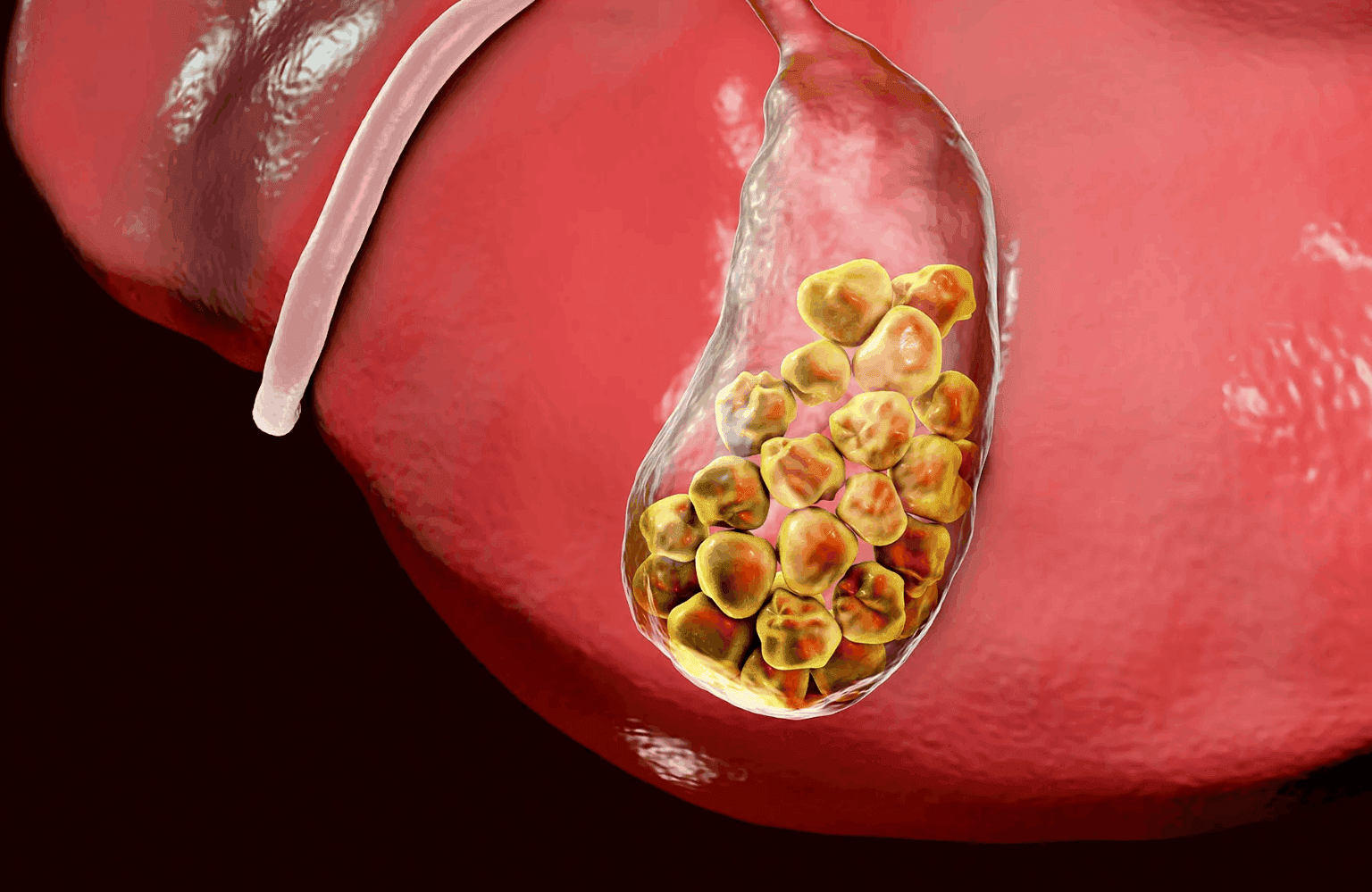Gallstones Symptoms and Causes