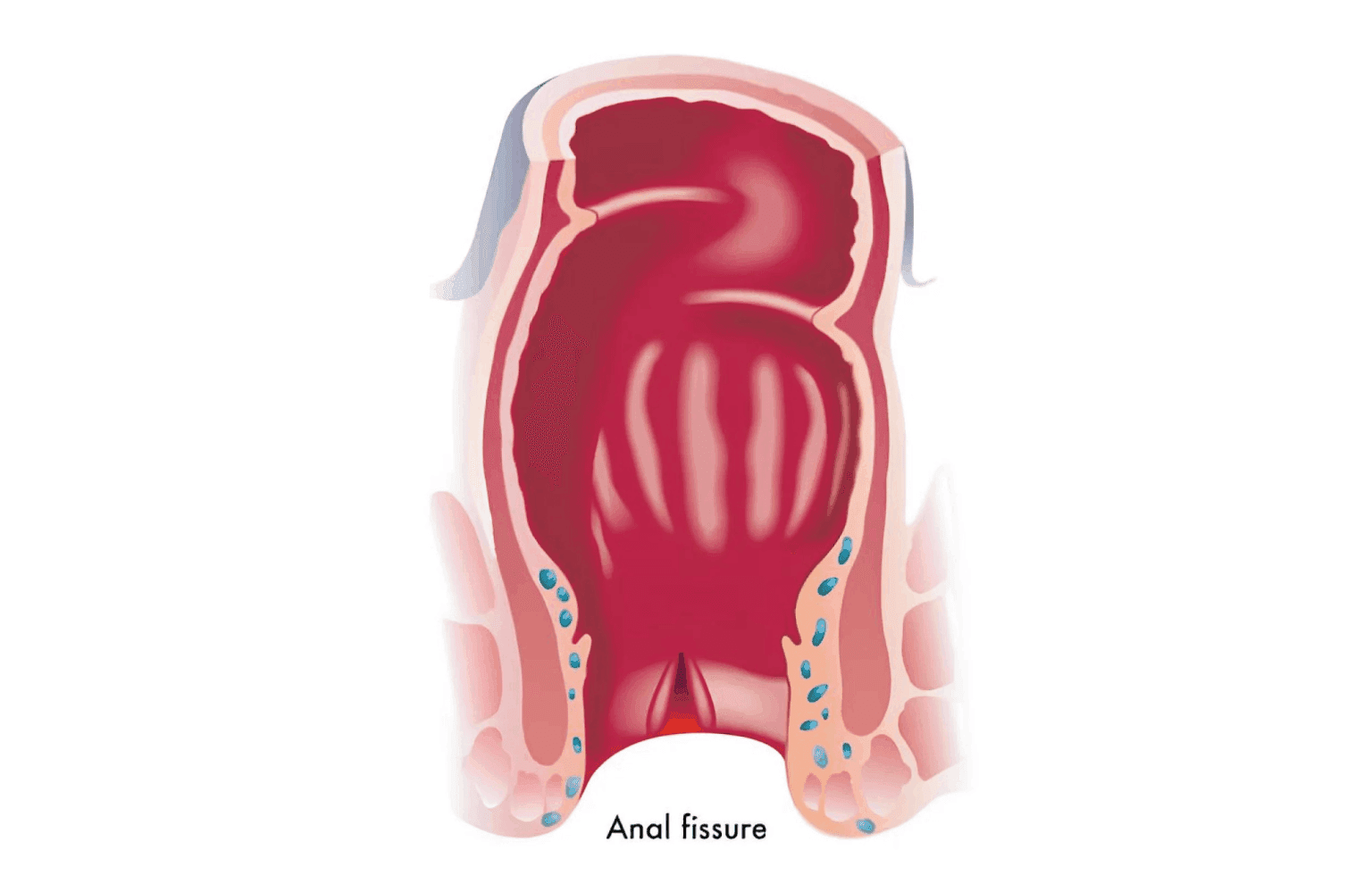 Anal fissure Home Remedies and the Ayurvedic View