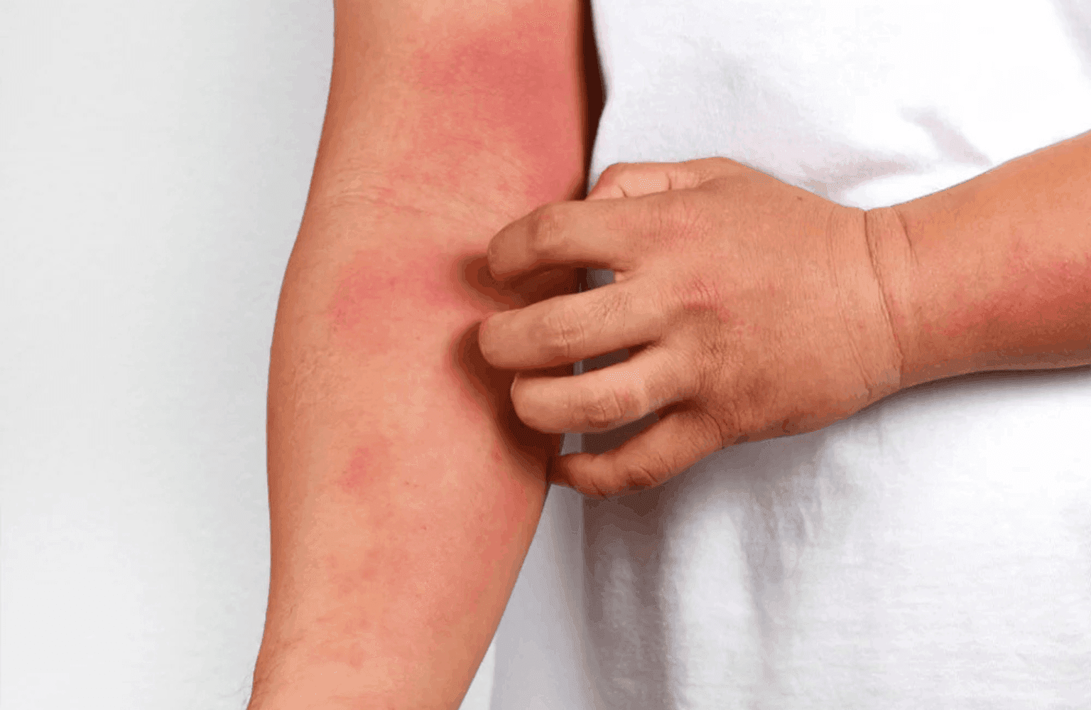 Heat rash Symptoms and Causes