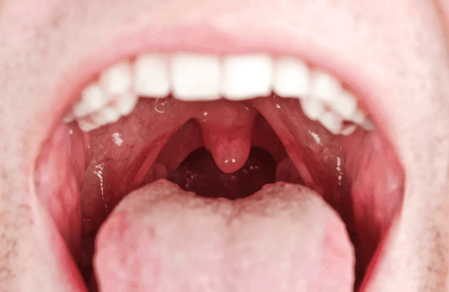 Throat infection Home Remedies and the Ayurvedic View