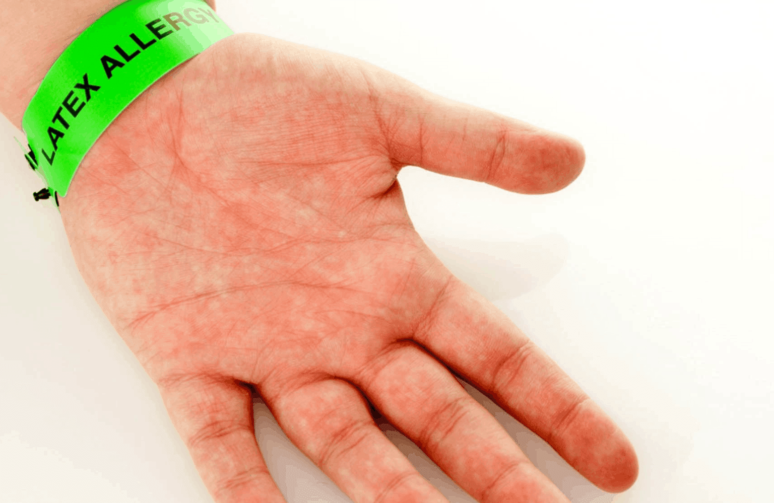 Latex Allergy Symptoms and Causes