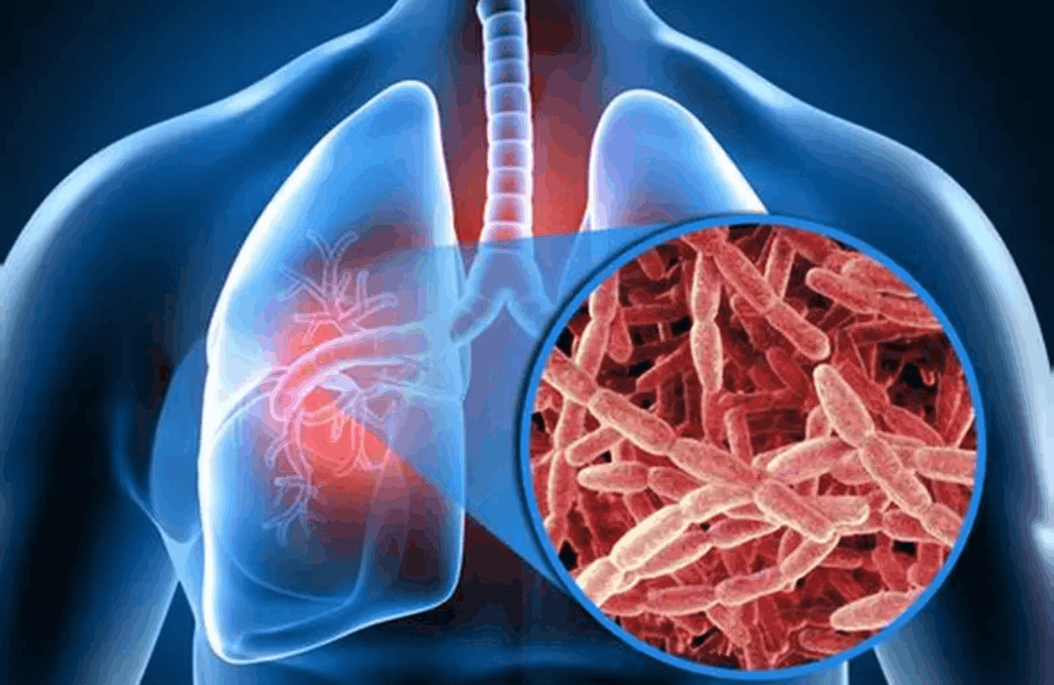 Tuberculosis