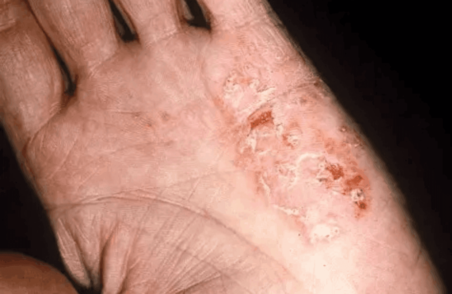 Eczema