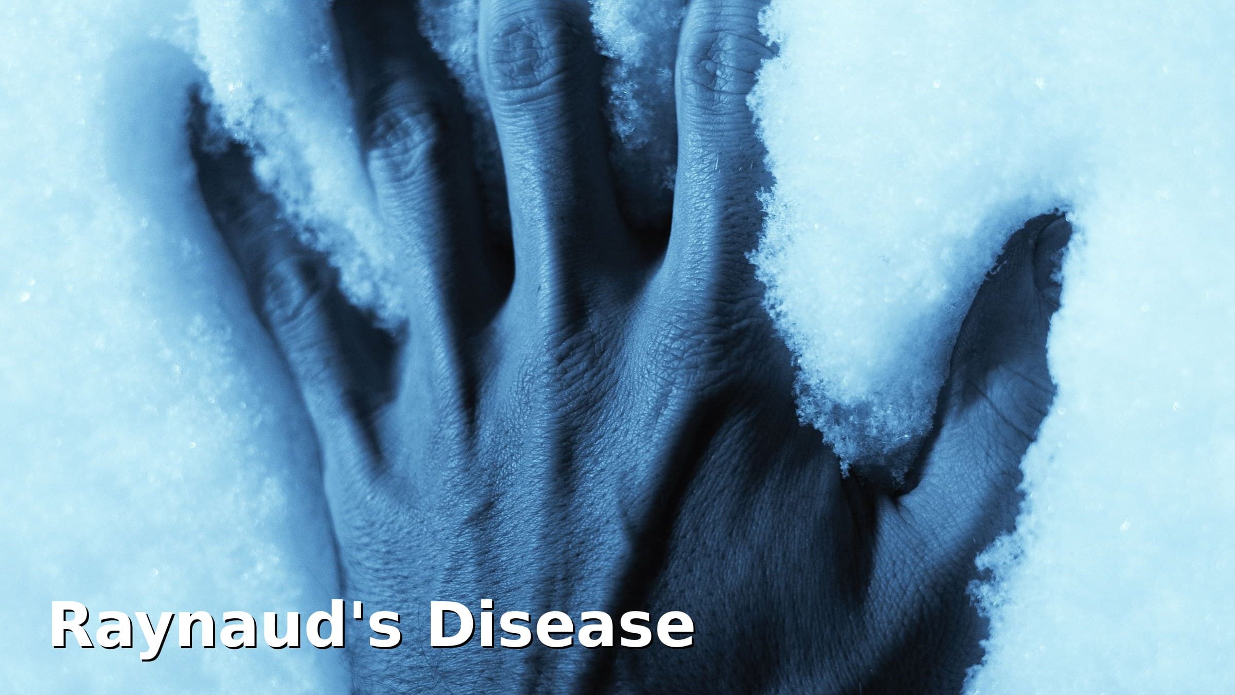 Raynaud's Disease