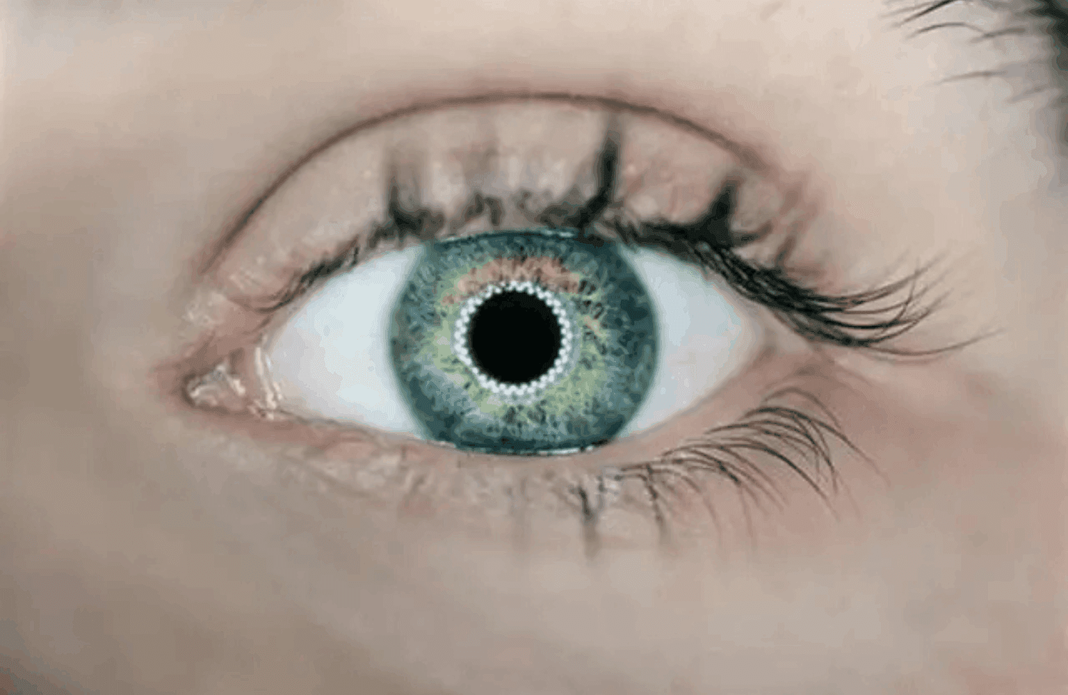 Glaucoma