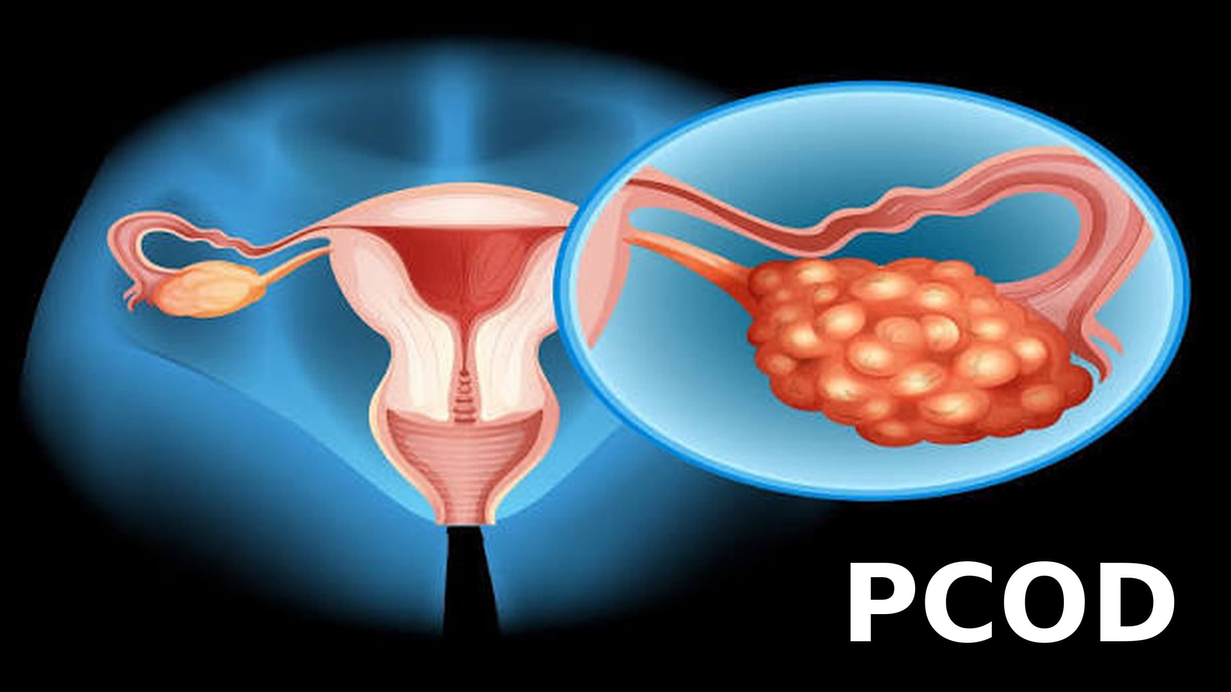 PCOD Symptoms and Causes