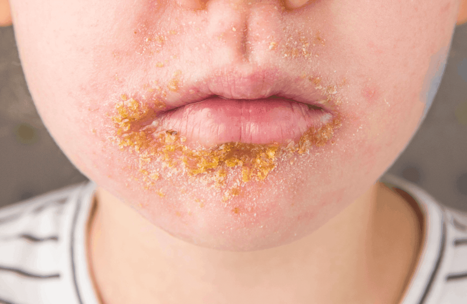 Impetigo