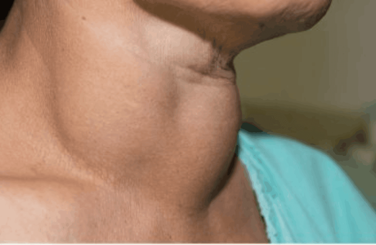 Goiter Symptoms and Causes