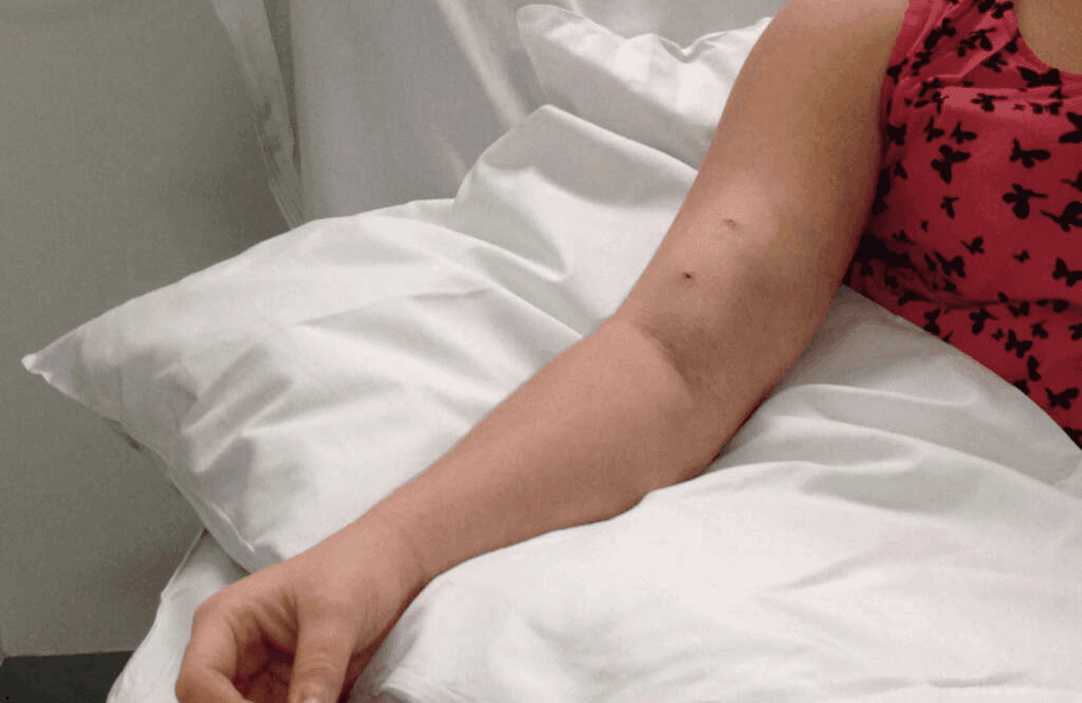 Fistula