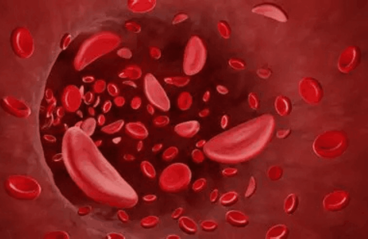 Anemia