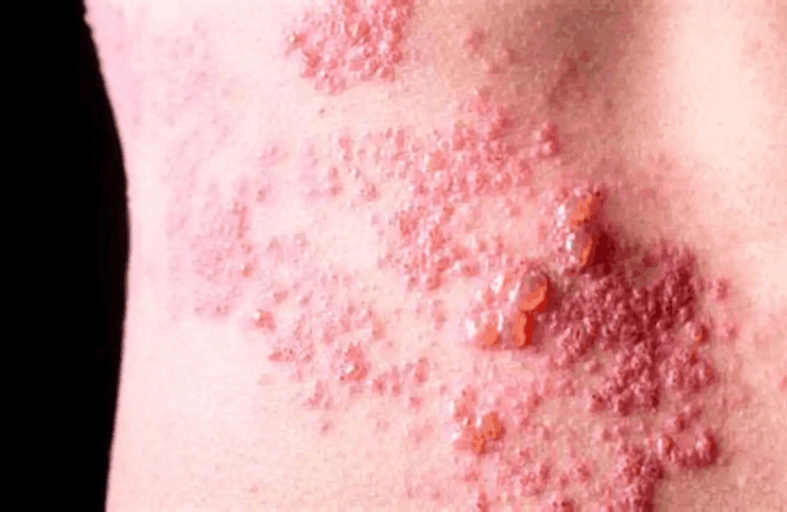 Herpes