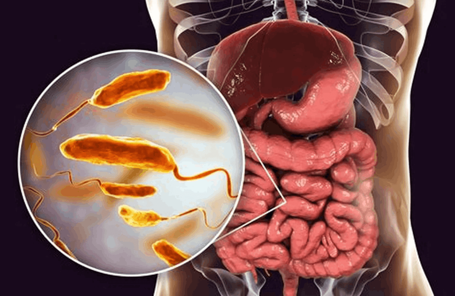 Cholera