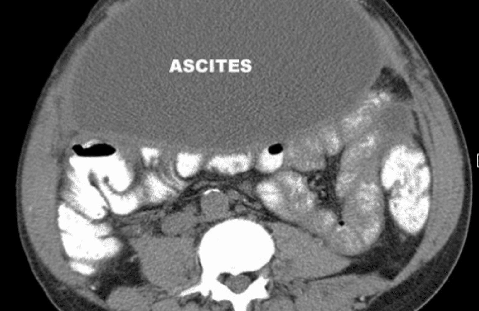 Ascites