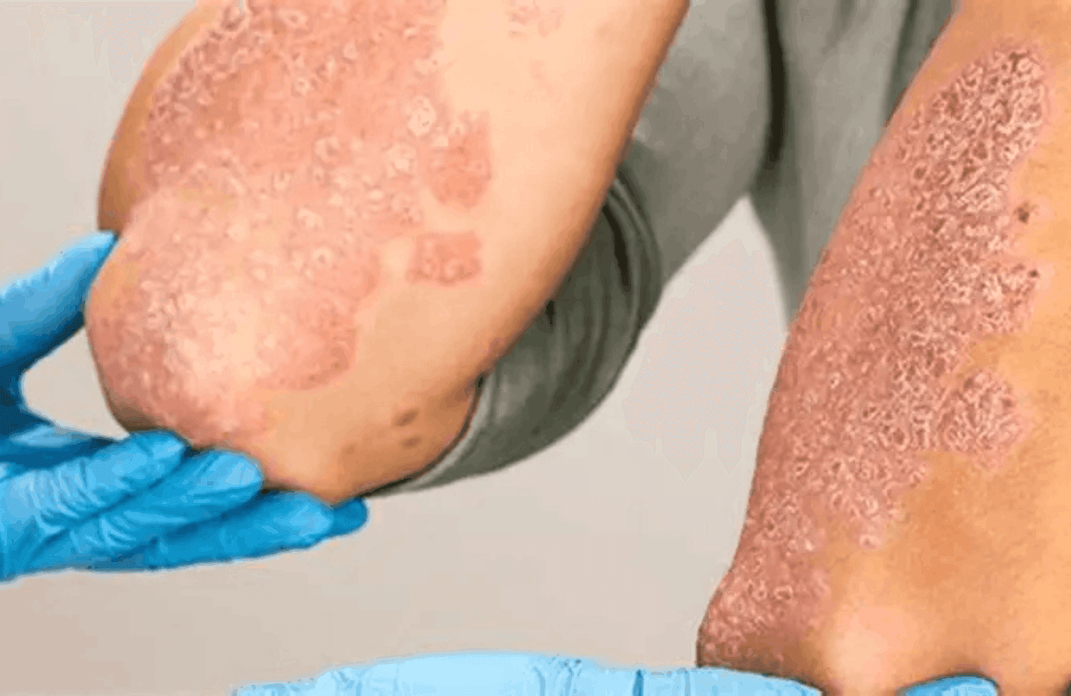 Psoriasis