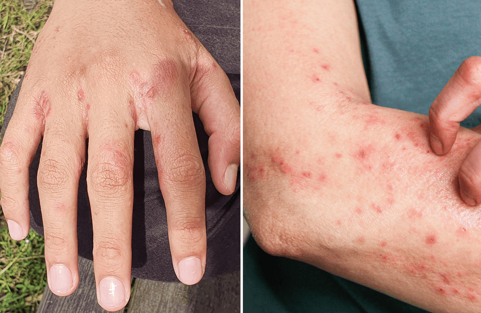 Scabies