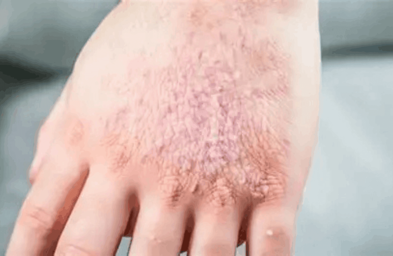 Dermatitis