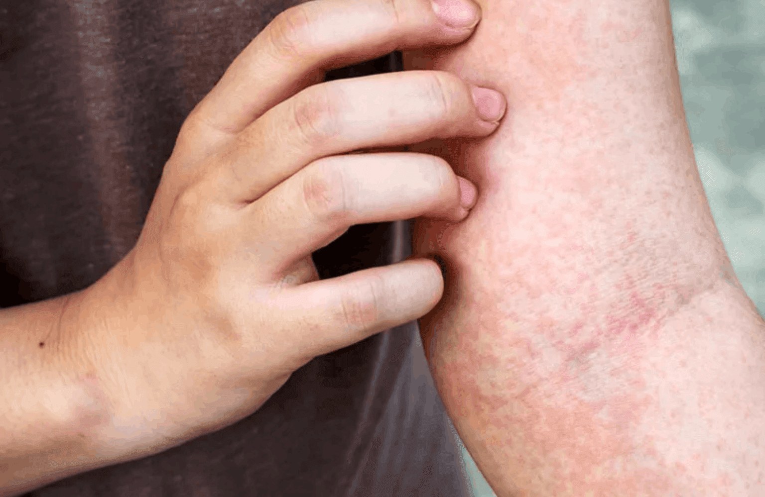 Skin allergy