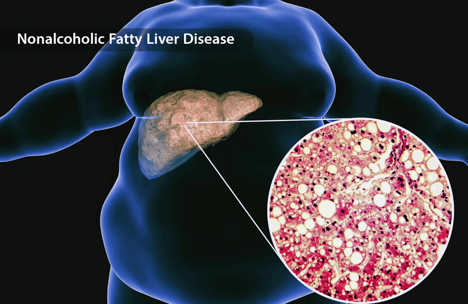 Fatty liver disease