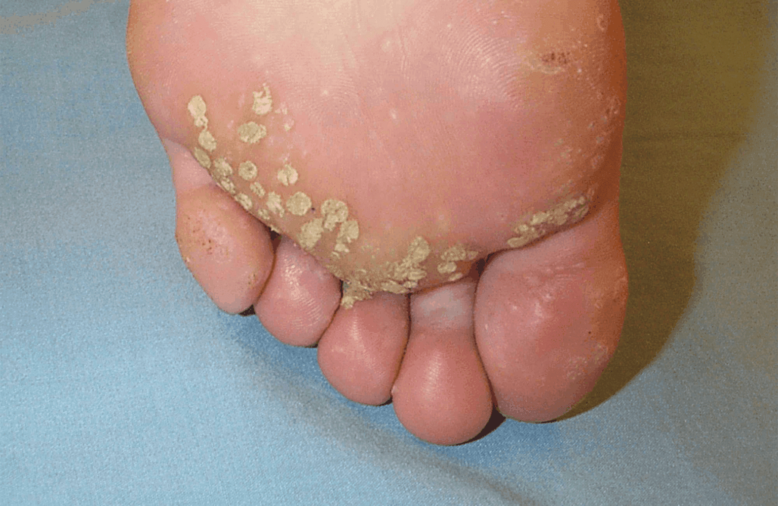 Warts Causes and Symptoms