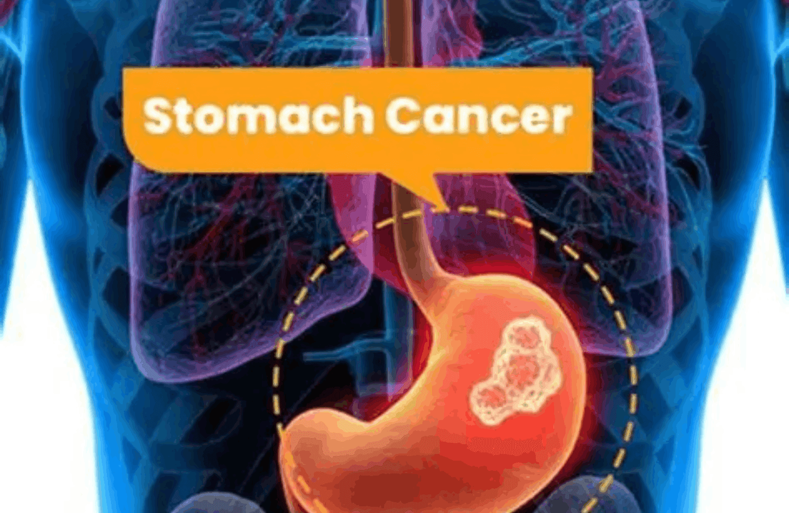 Stomach cancer Symptoms and Causes