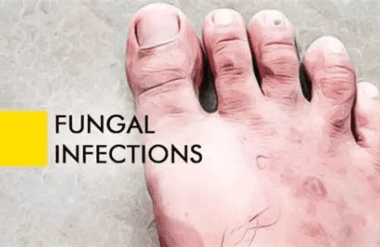 Fungal infection