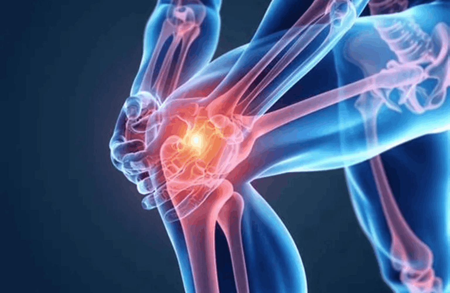 Arthritis