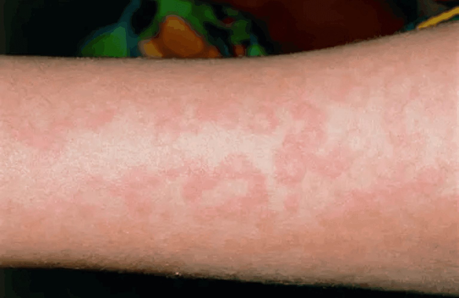 Urticaria