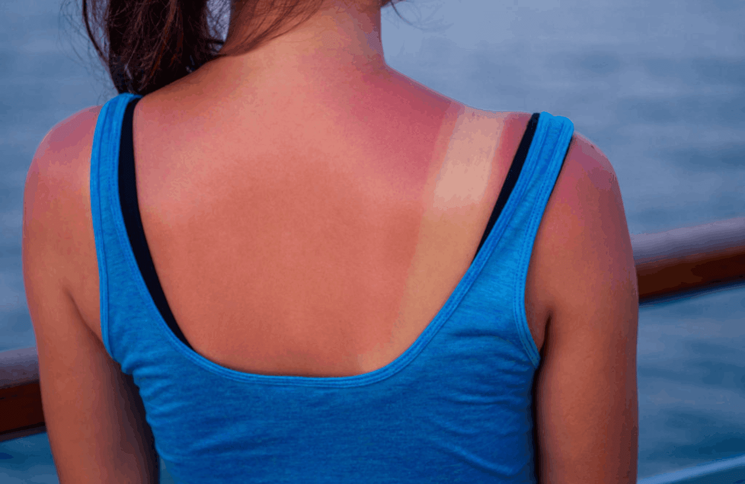 Sunburn