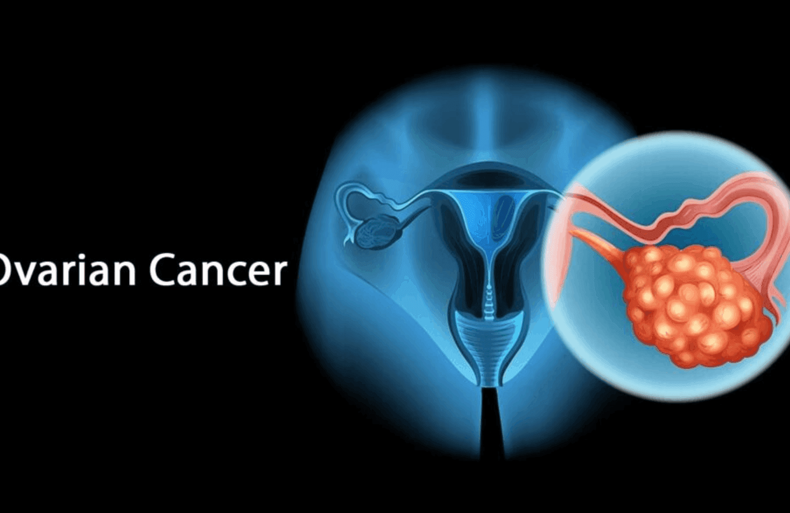 Ovarian cancer Symptoms and Causes