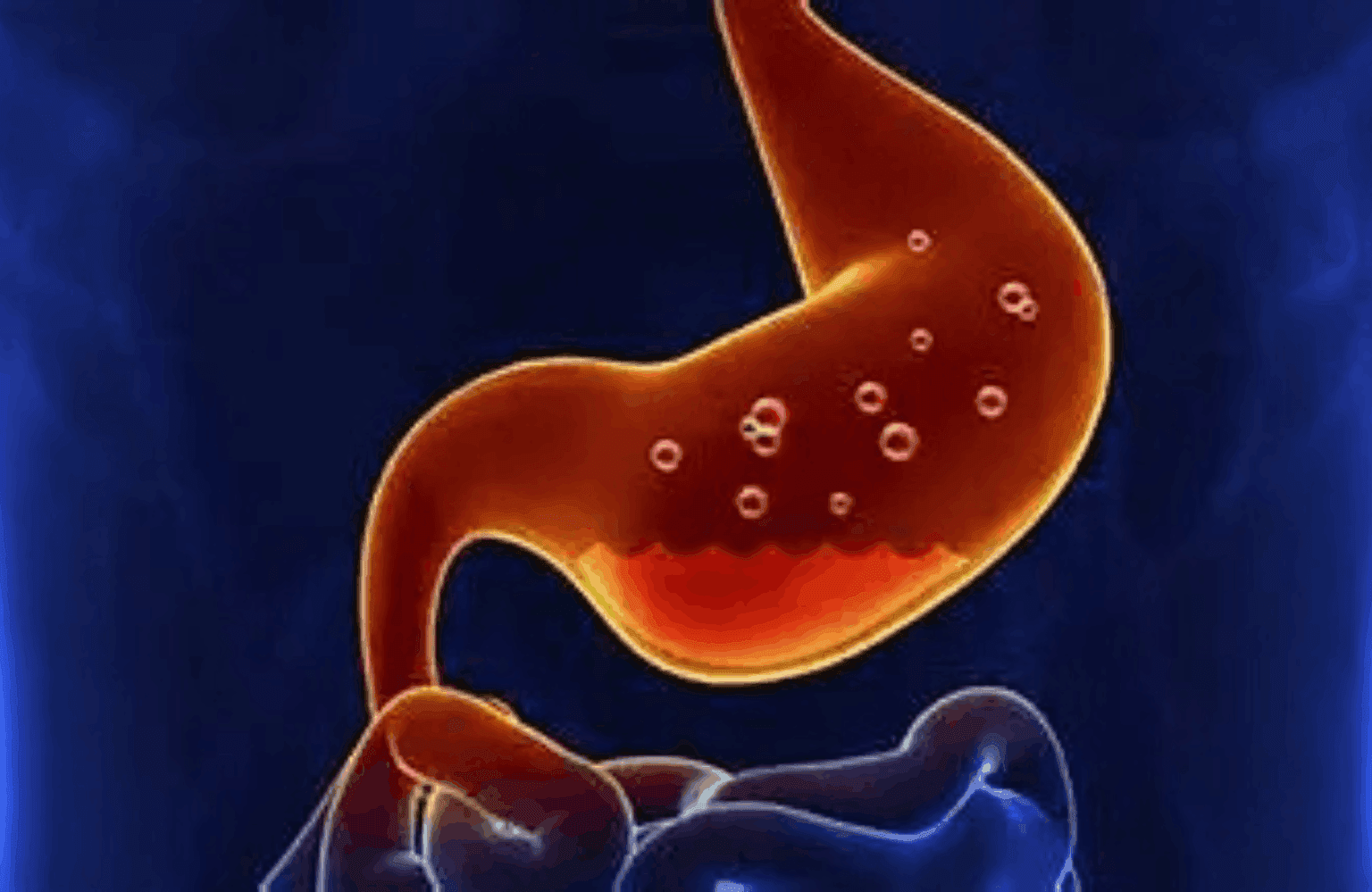 Peptic ulcer