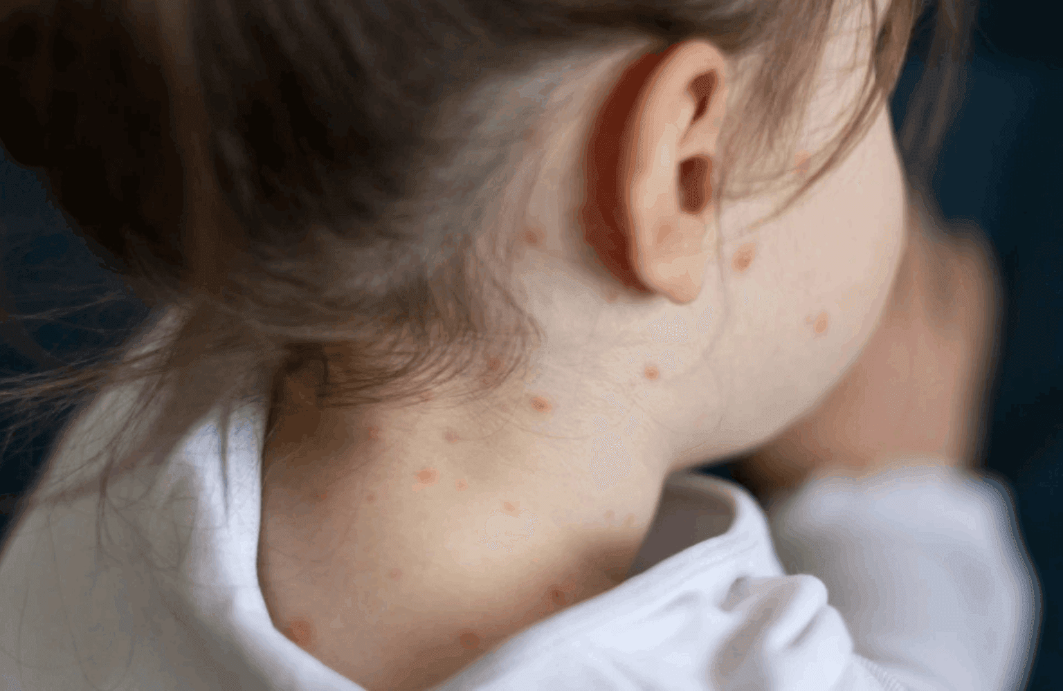 Measles