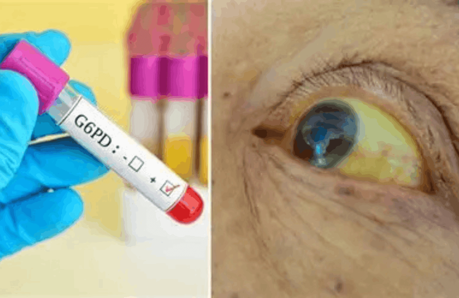 G6PD Deficiency Causes and Symptoms