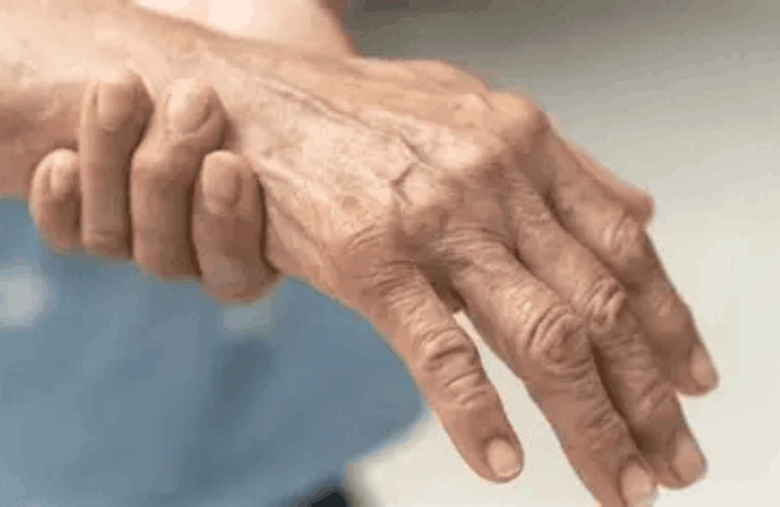 Rheumatoid arthritis