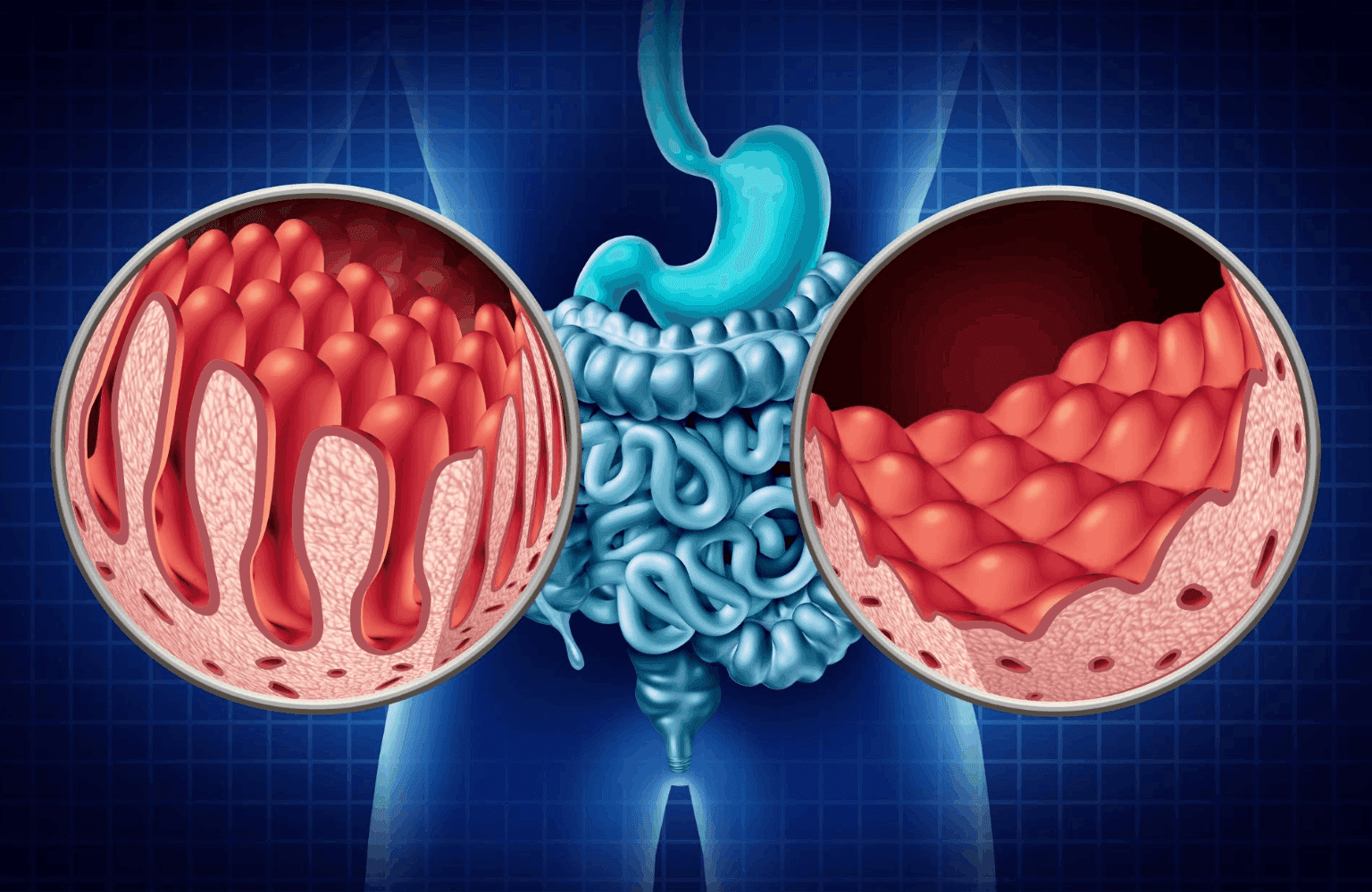 Celiac disease Symptoms and Causes