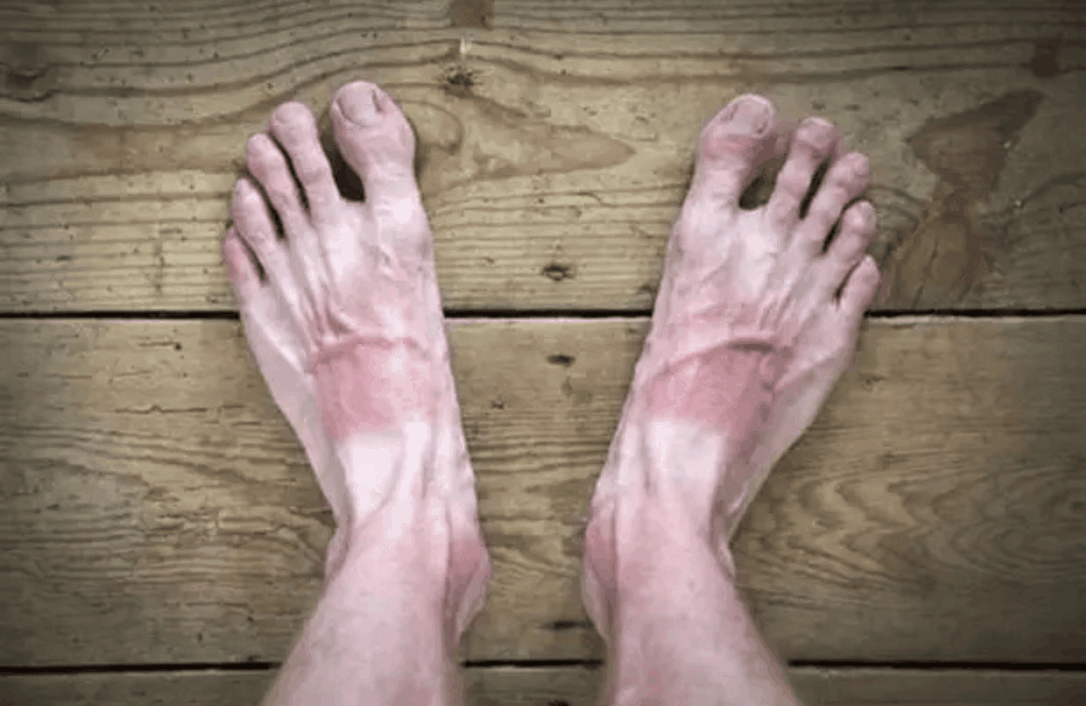 Gout