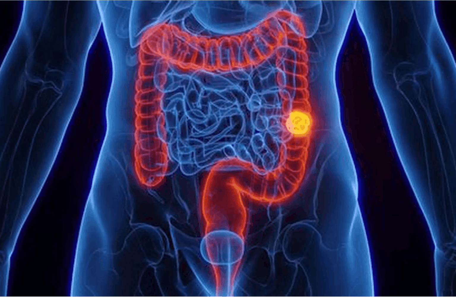 Colon cancer Symptoms and Causes