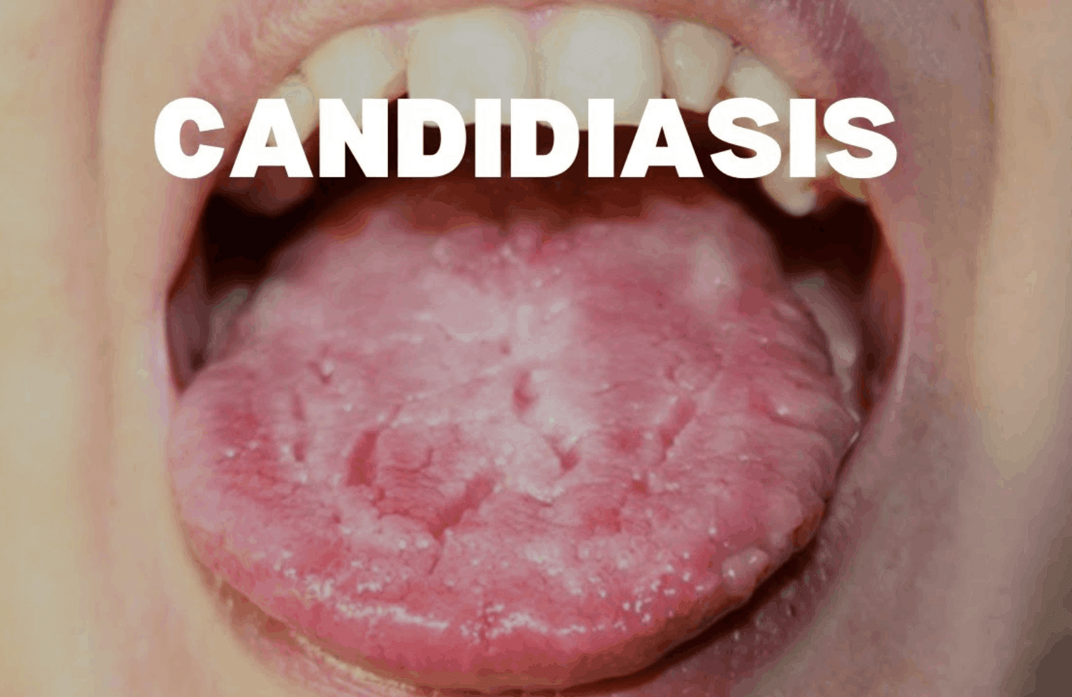 Candidiasis Symptoms and Causes