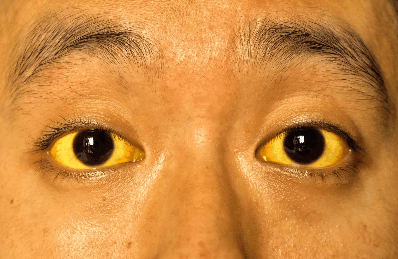Jaundice