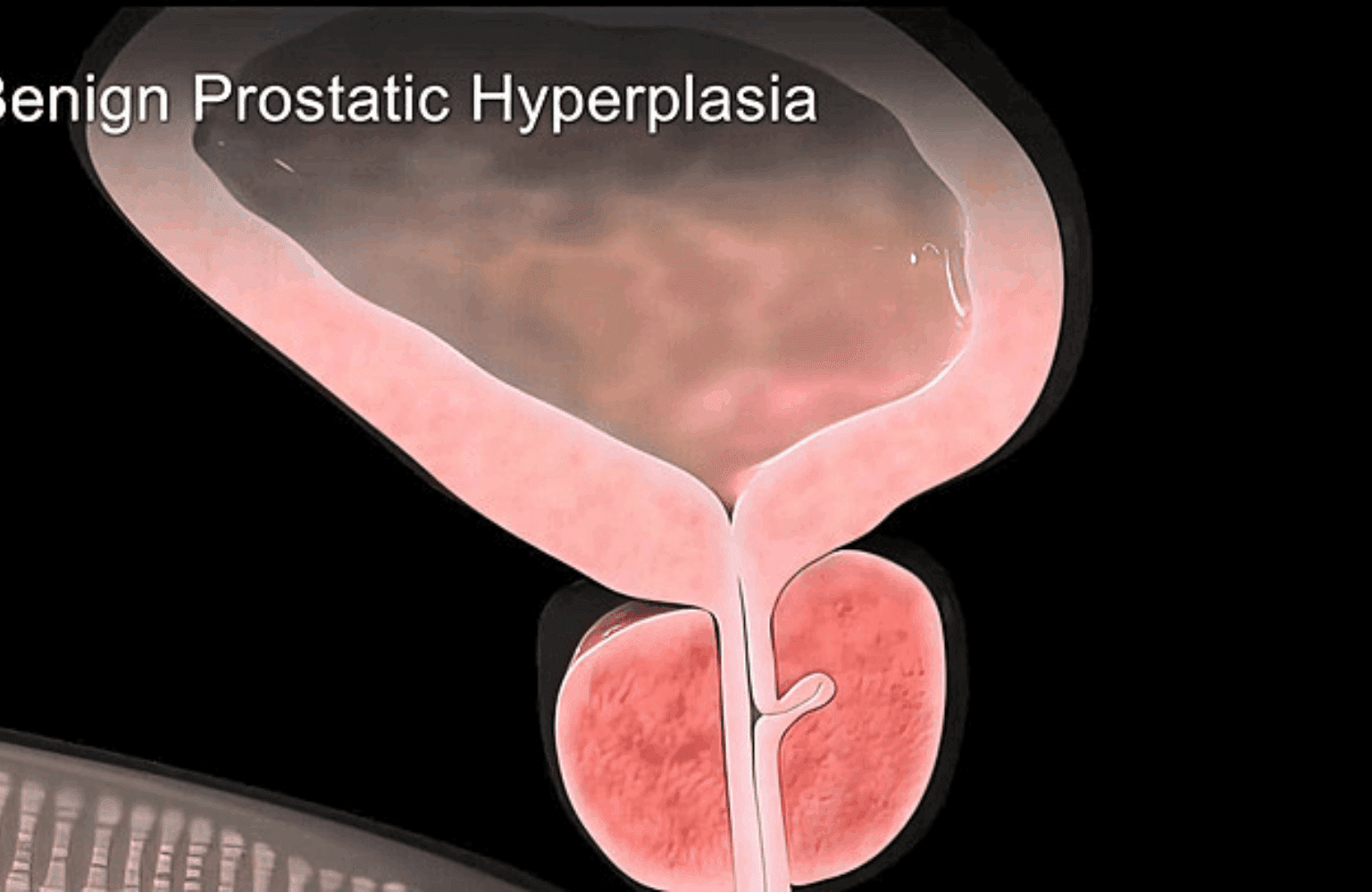 Benign prostatic hyperplasia Symptoms and Causes